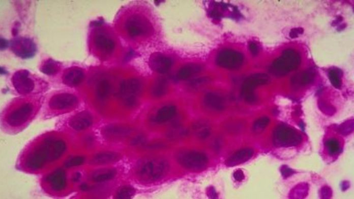 SUS estuda adoção de tratamento promissor contra câncer