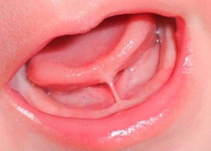 Marabá: mutirão de cirurgias corrige ‘língua presa’ em bebês