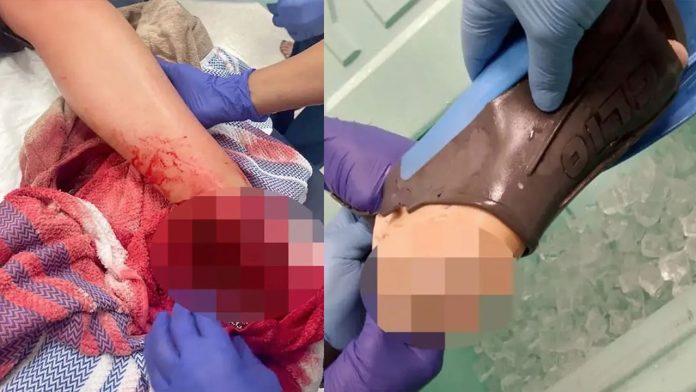 Turista tem pé arrancado por tubarão no Caribe