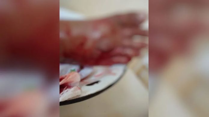 Adolescente é atacado por jacaré no em Santarém, no Pará